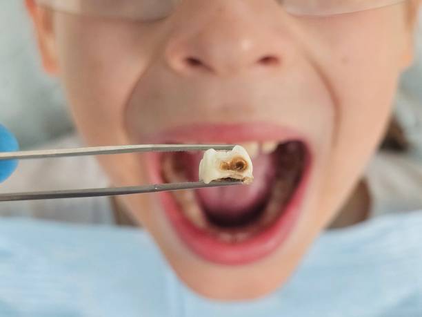 Best Emergency Tooth Extraction in West Swanzey, NH